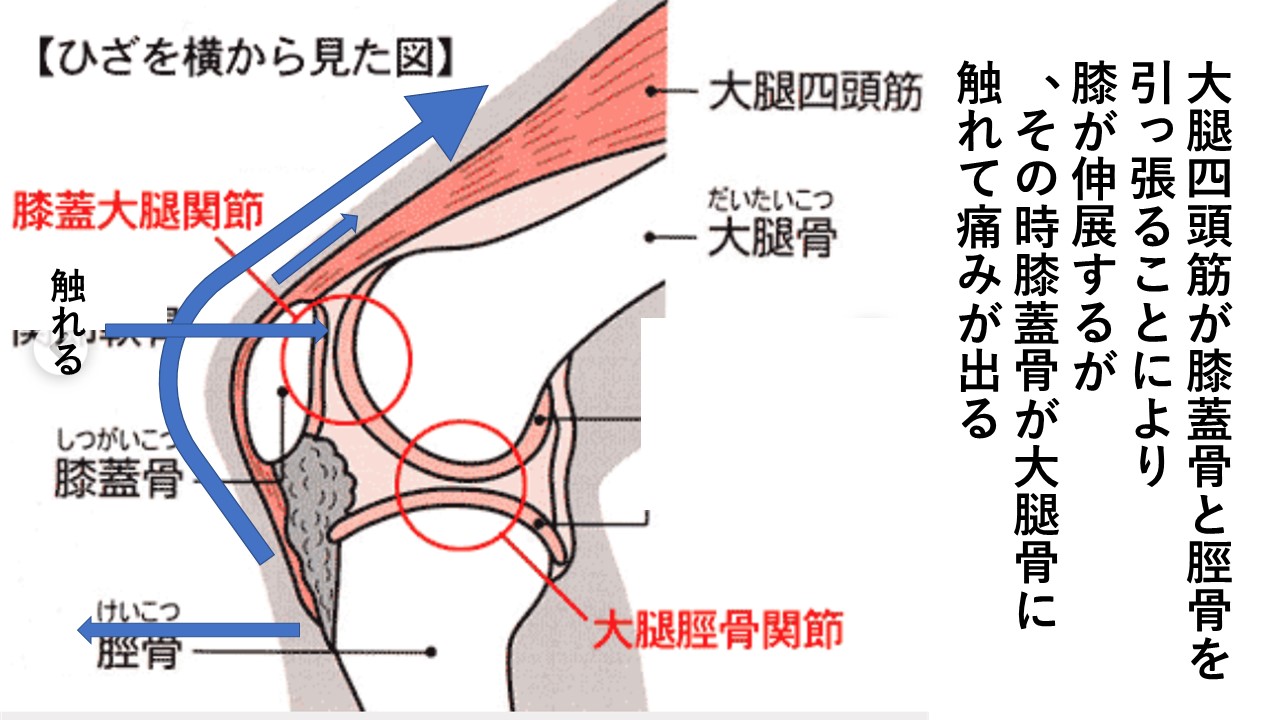 若い人の膝の痛み 膝蓋大腿関節症 東邦マッサージグループ